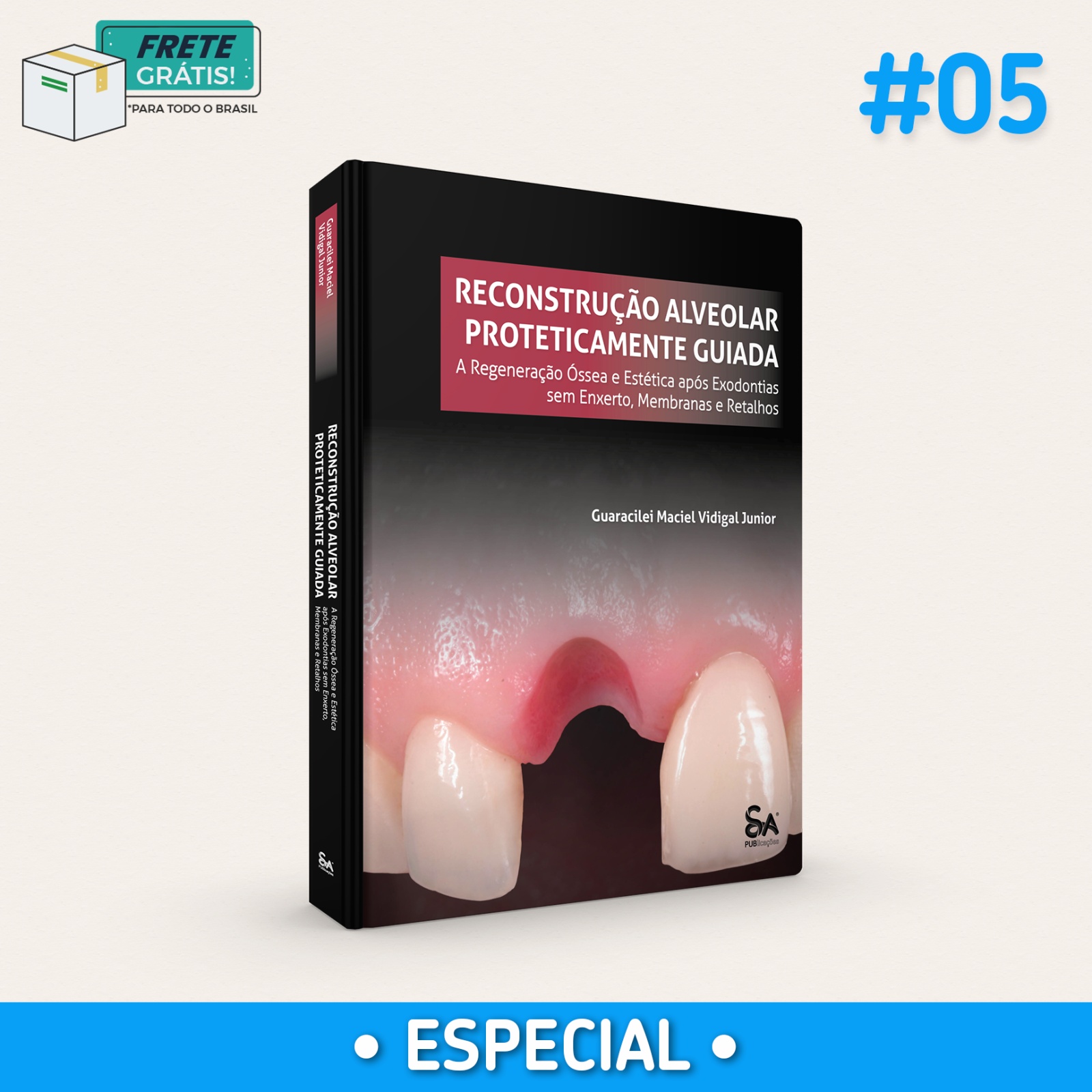 Reconstrução Alveolar Proteticamente Guiada (RAPG): A Regeneração Óssea e Estética após Exodontias sem Enxerto, Membranas e Retalhos (Especial V05)